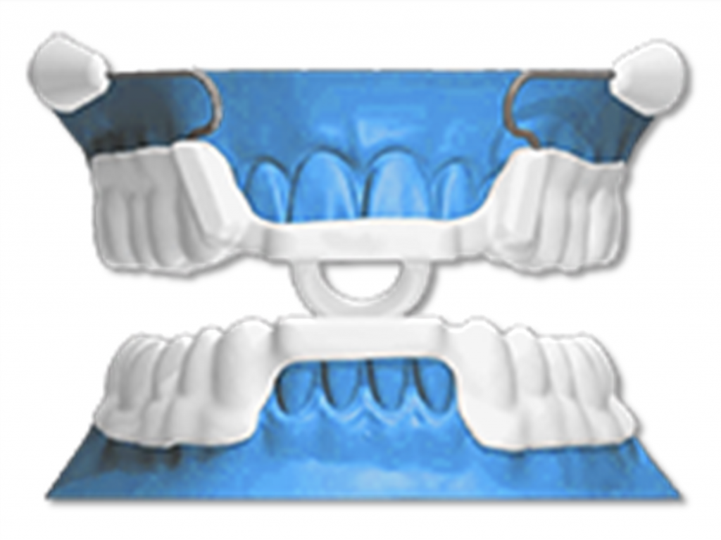 Occlusal Splint Therapy Cairns TMD Treatment Future Dental